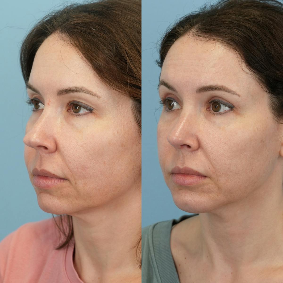 Rhinoplasty Before & After Gallery - Patient 982554 - Image 5
