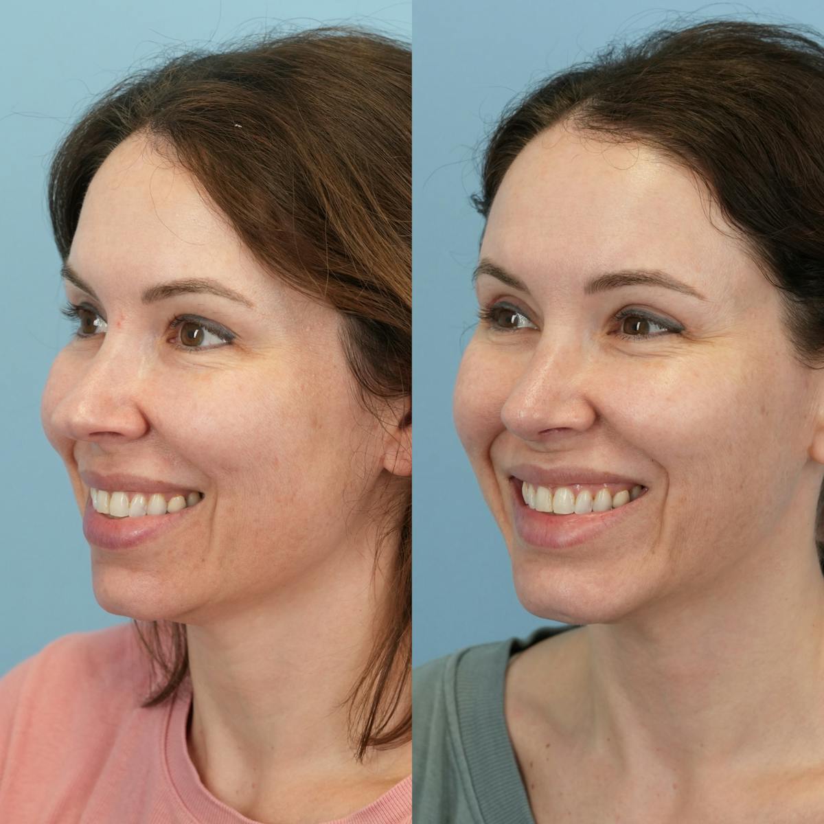 Rhinoplasty Before & After Gallery - Patient 982554 - Image 6
