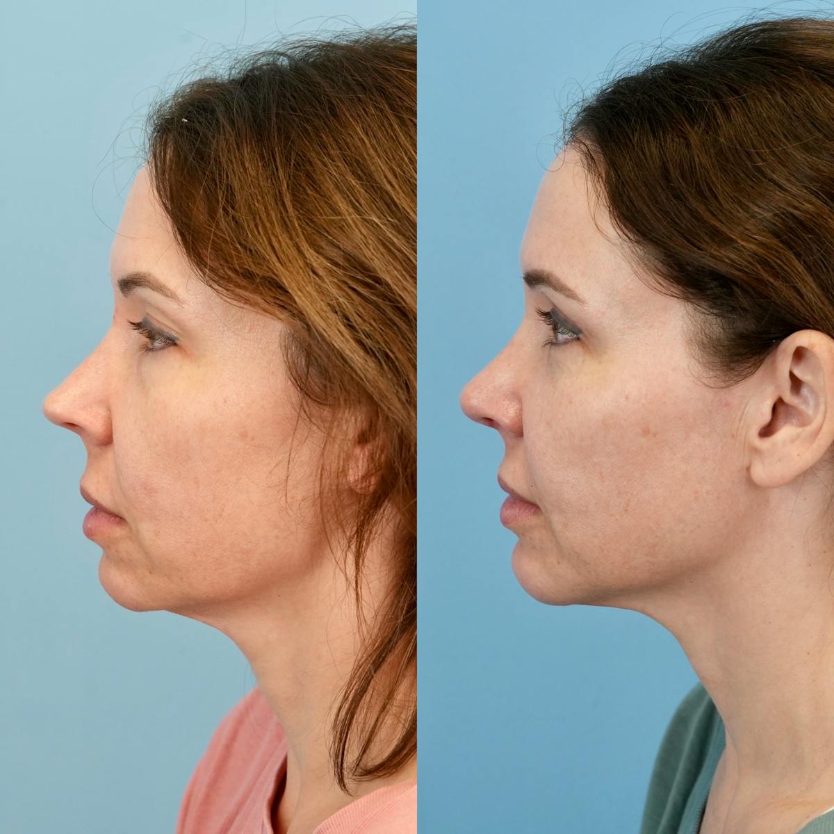Rhinoplasty Before & After Gallery - Patient 982554 - Image 7