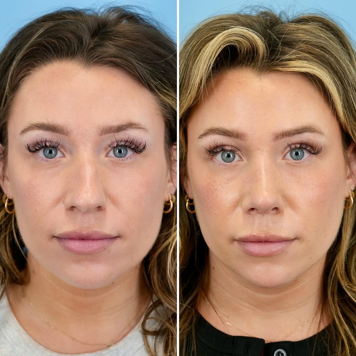 Rhinoplasty Before & After Gallery - Patient 331701 - Image 5