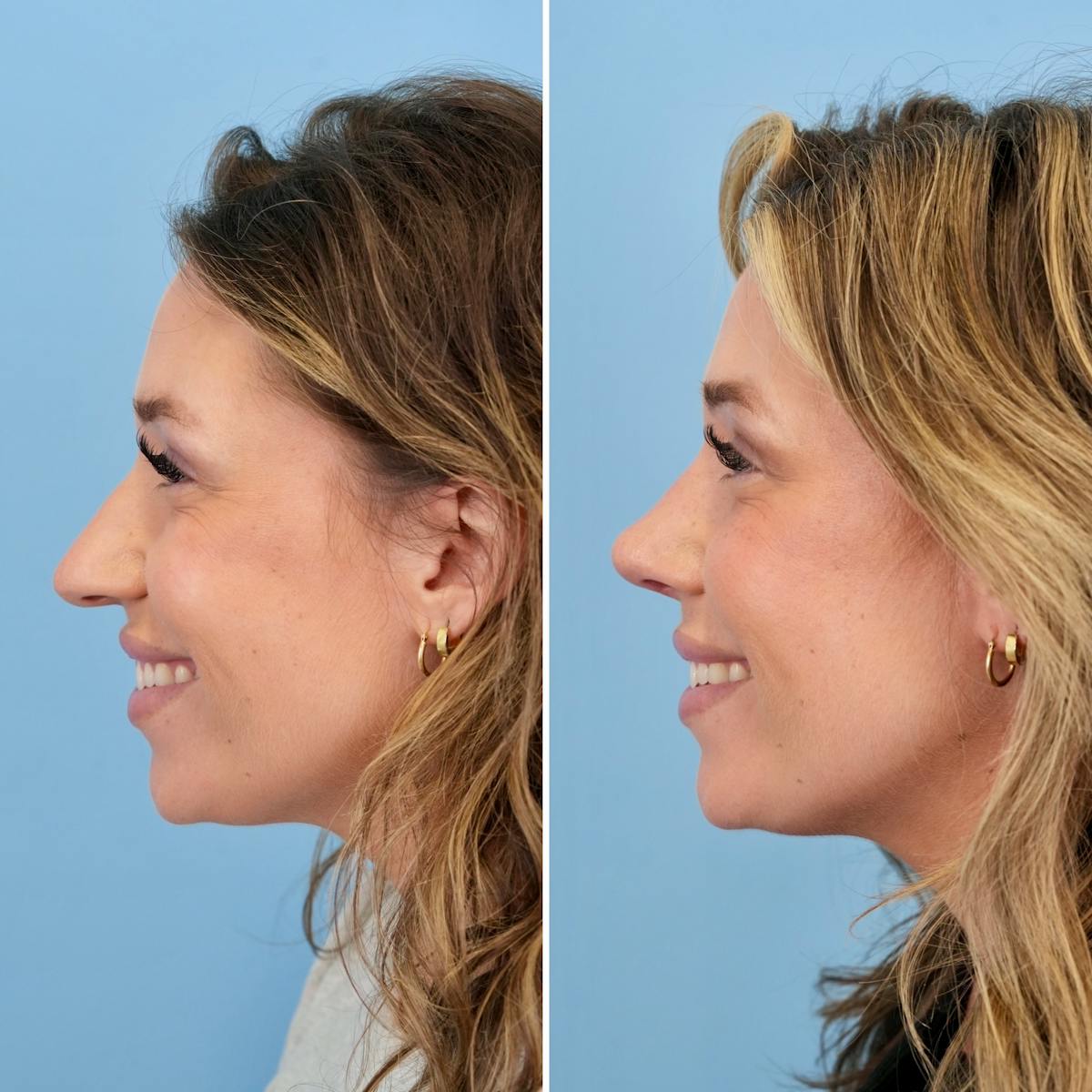 Rhinoplasty Before & After Gallery - Patient 331701 - Image 9