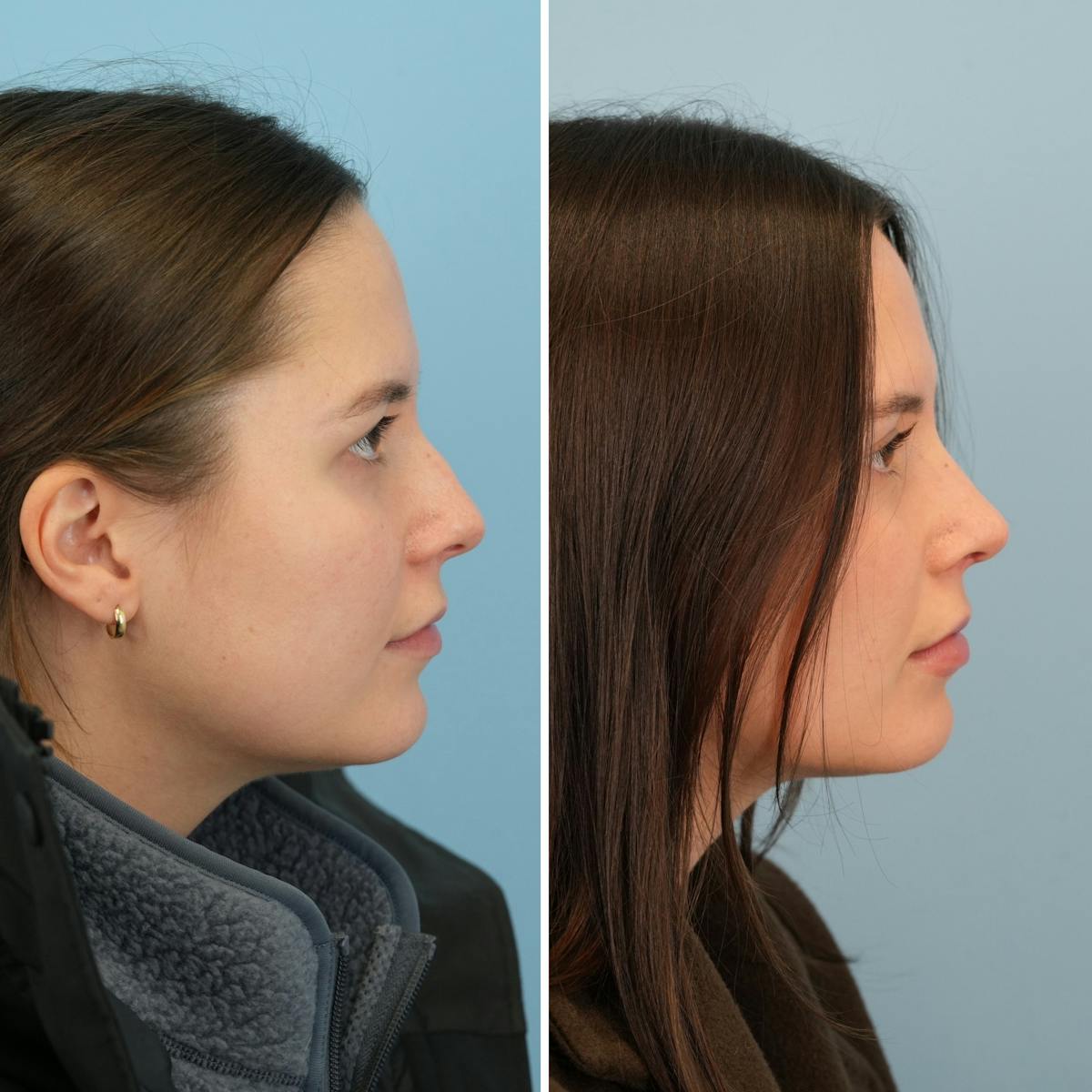 Rhinoplasty Before & After Gallery - Patient 414222 - Image 1