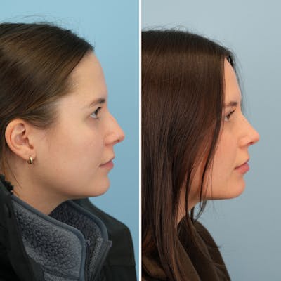Rhinoplasty Before & After Gallery - Patient 414222 - Image 1