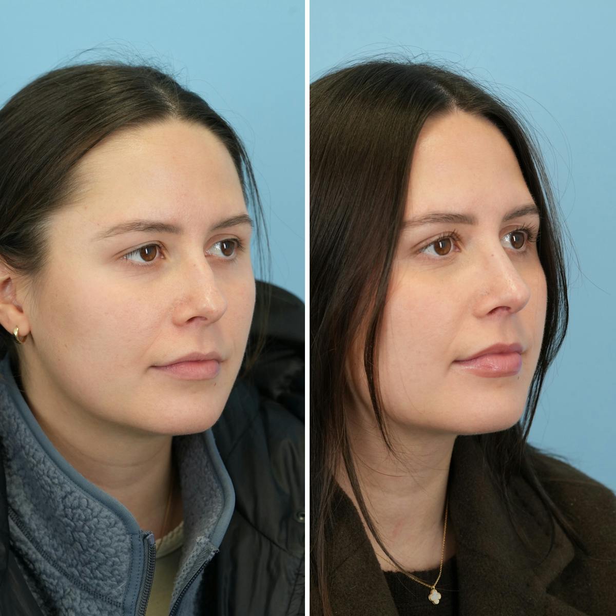 Rhinoplasty Before & After Gallery - Patient 414222 - Image 2
