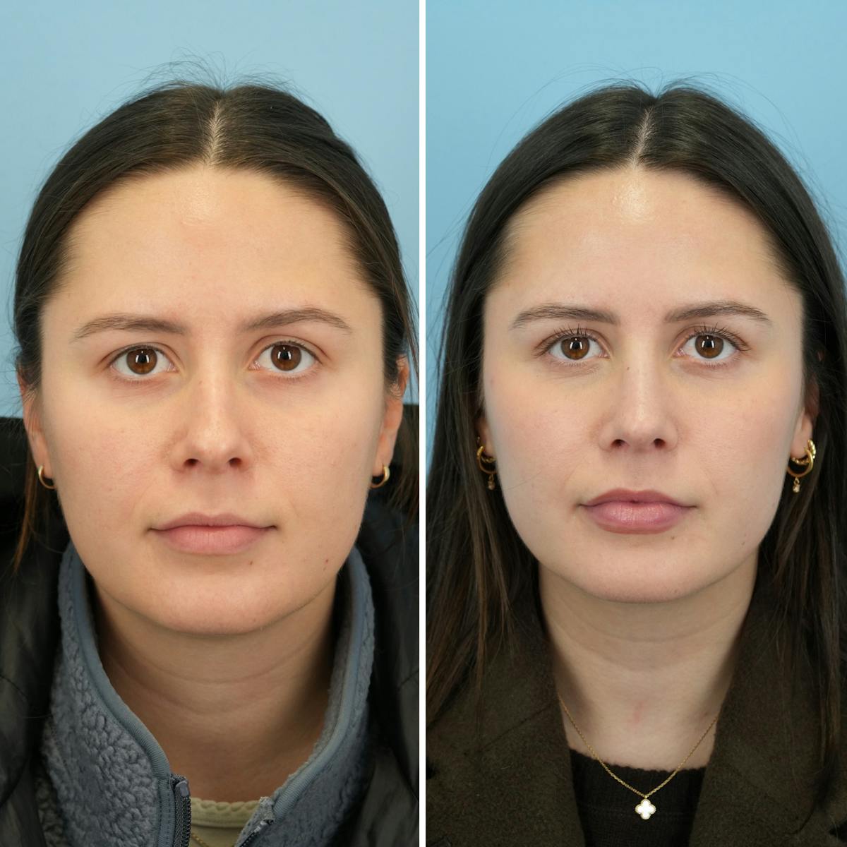 Rhinoplasty Before & After Gallery - Patient 414222 - Image 3
