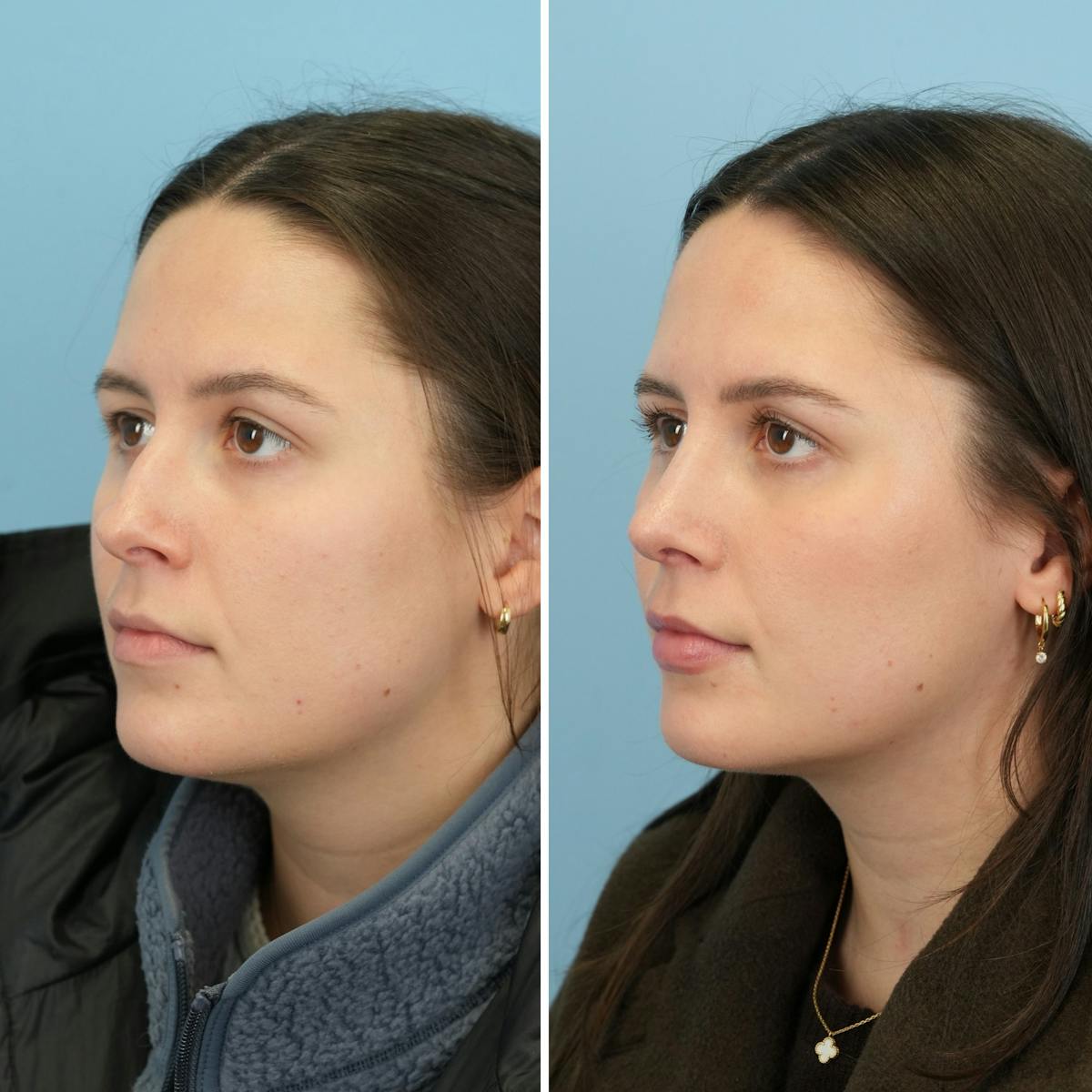 Rhinoplasty Before & After Gallery - Patient 414222 - Image 4