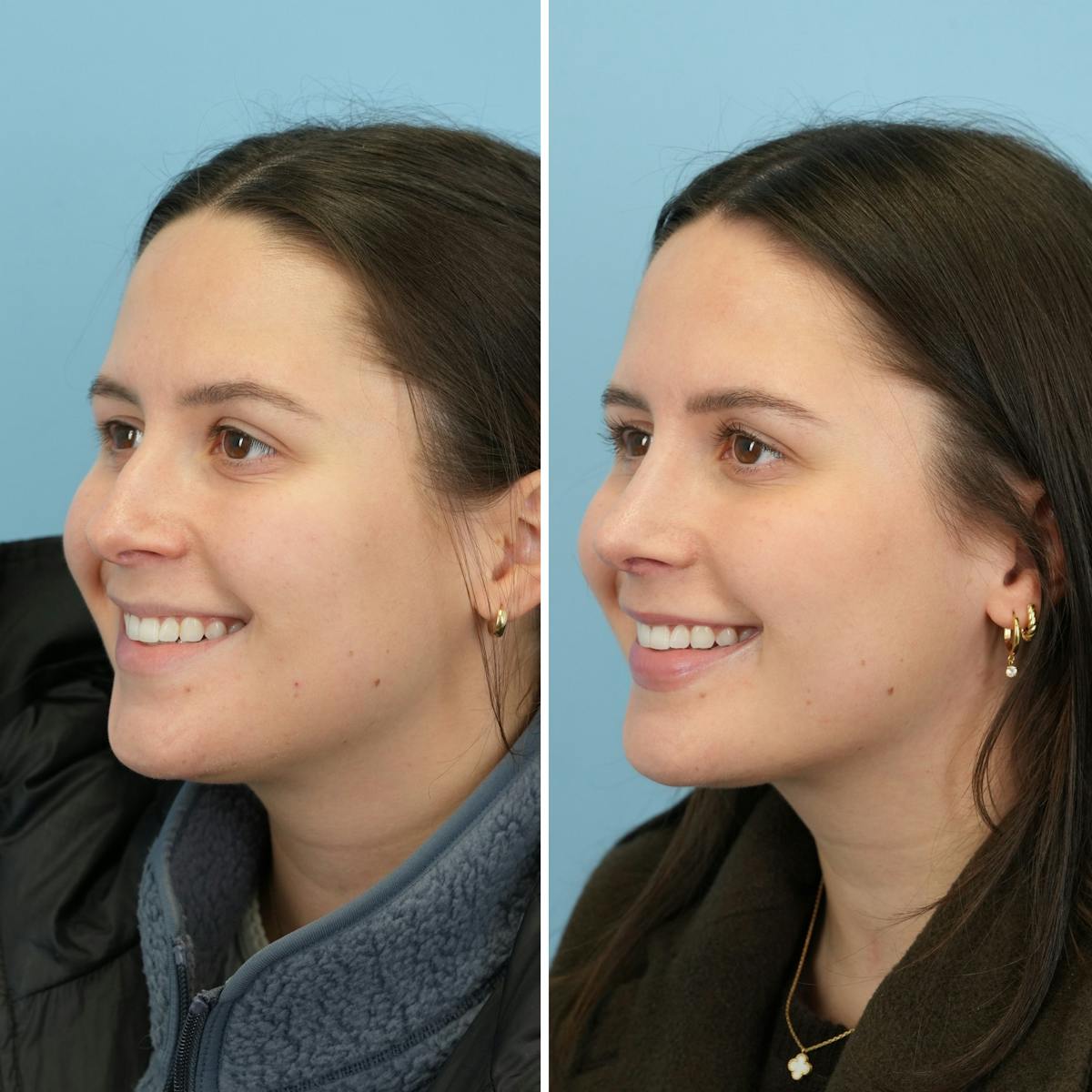 Rhinoplasty Before & After Gallery - Patient 414222 - Image 5