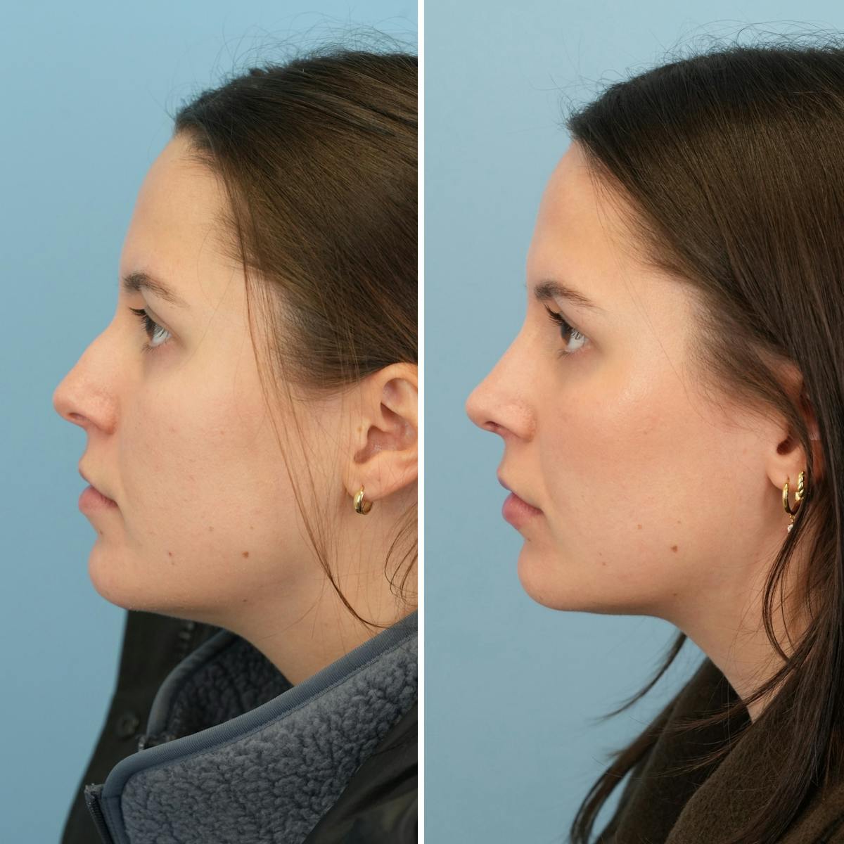 Rhinoplasty Before & After Gallery - Patient 414222 - Image 6