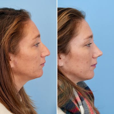 Rhinoplasty Before & After Gallery - Patient 215734 - Image 1