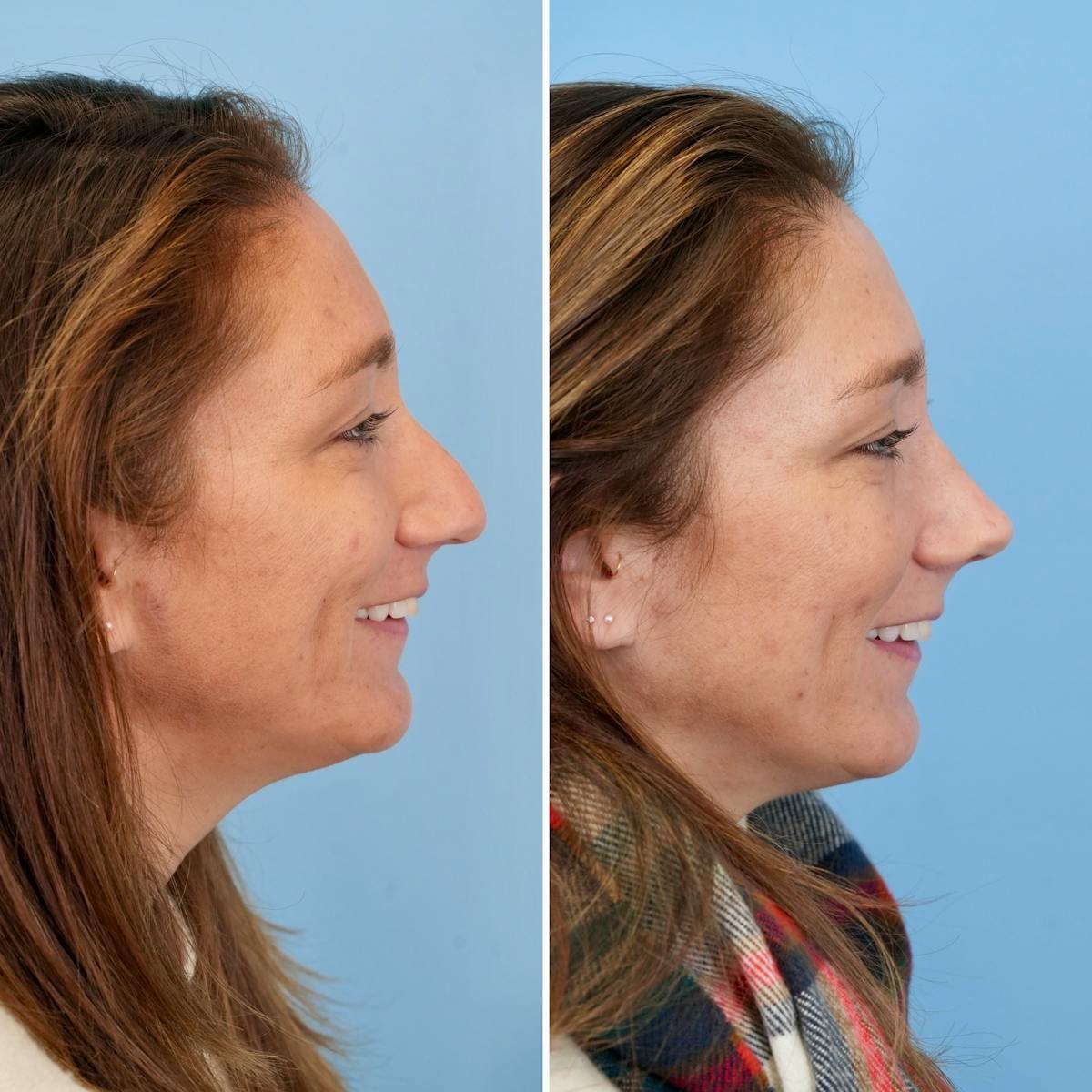 Rhinoplasty Before & After Gallery - Patient 215734 - Image 2