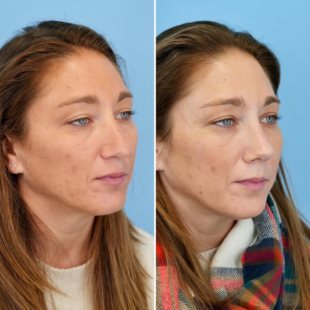 Rhinoplasty Before & After Gallery - Patient 215734 - Image 3