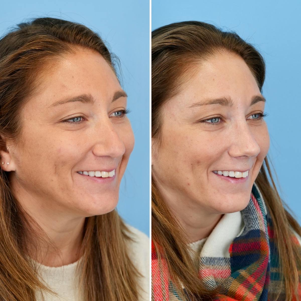 Rhinoplasty Before & After Gallery - Patient 215734 - Image 4