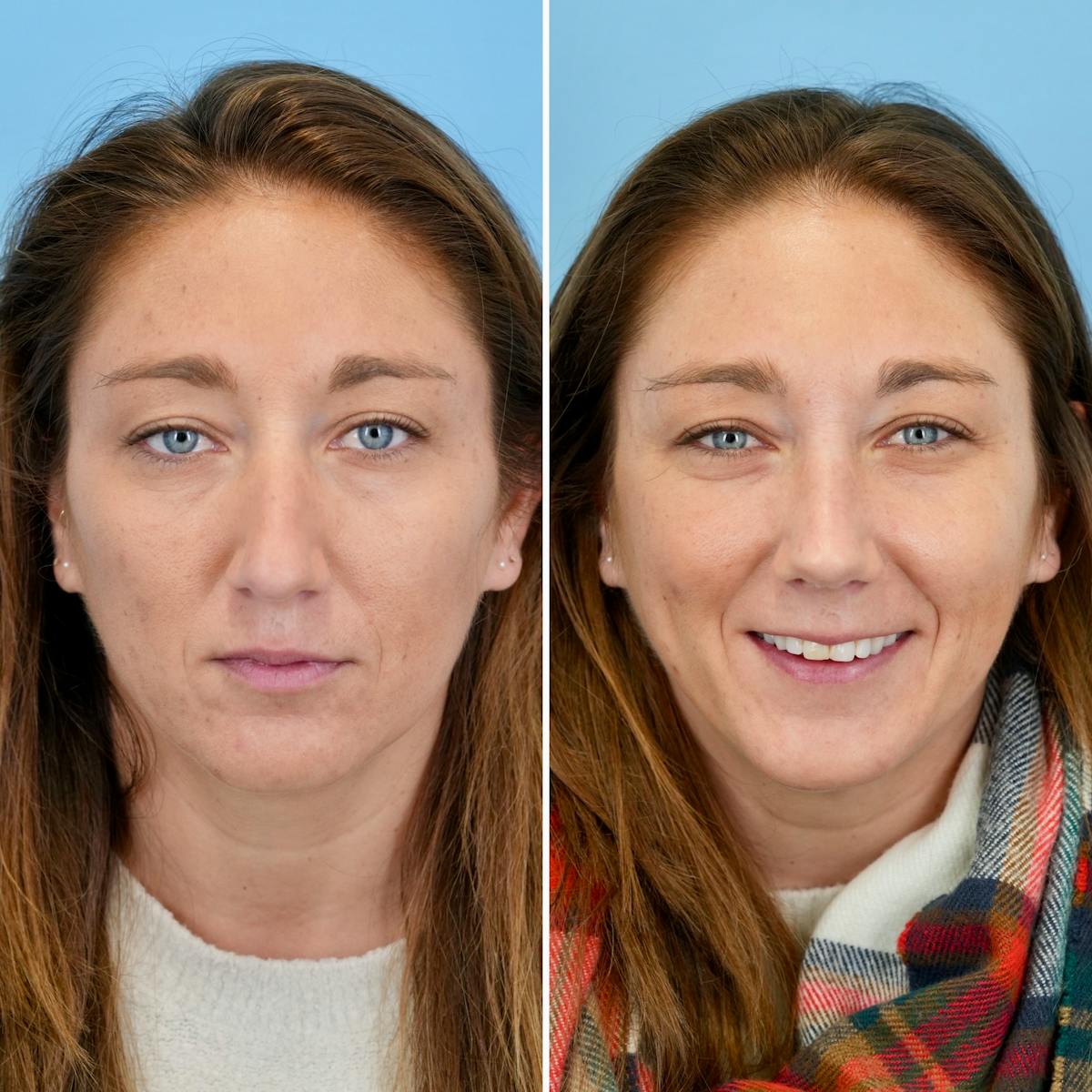 Rhinoplasty Before & After Gallery - Patient 215734 - Image 5