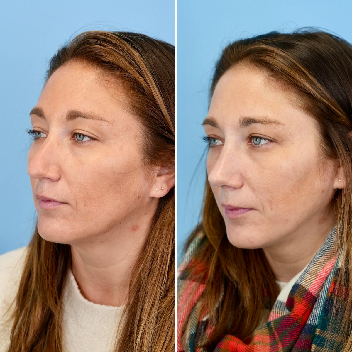 Rhinoplasty Before & After Gallery - Patient 215734 - Image 6