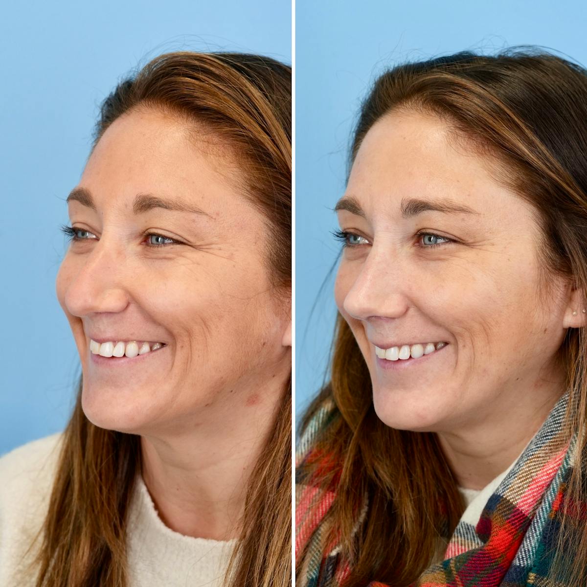 Rhinoplasty Before & After Gallery - Patient 215734 - Image 7