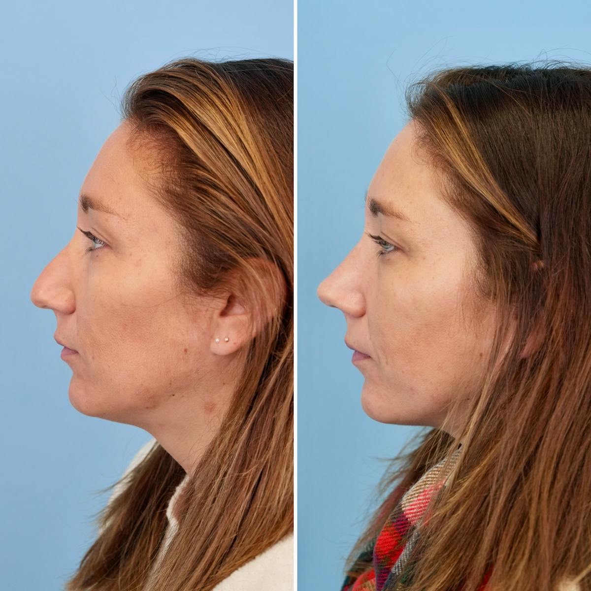 Rhinoplasty Before & After Gallery - Patient 215734 - Image 8
