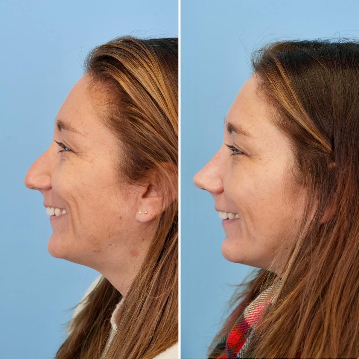 Rhinoplasty Before & After Gallery - Patient 215734 - Image 9