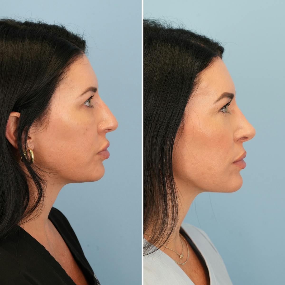 Rhinoplasty Before & After Gallery - Patient 132503 - Image 1