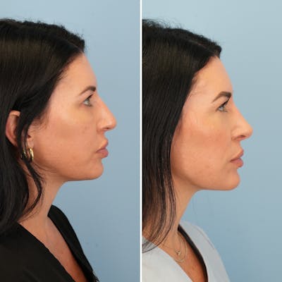 Rhinoplasty Before & After Gallery - Patient 132503 - Image 1