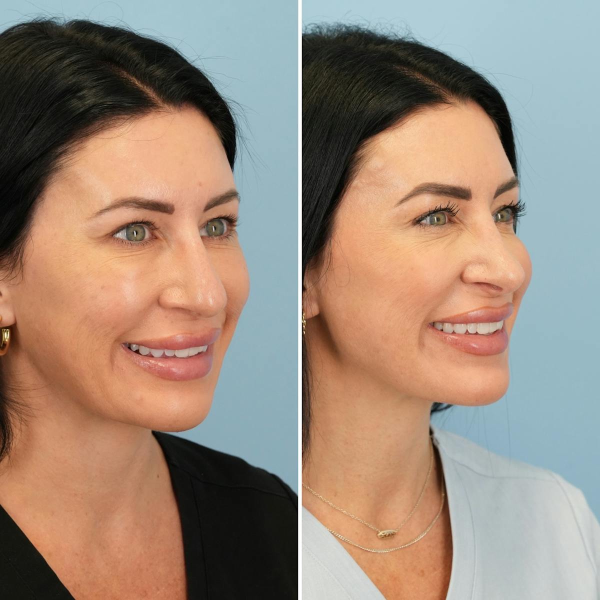 Rhinoplasty Before & After Gallery - Patient 132503 - Image 4