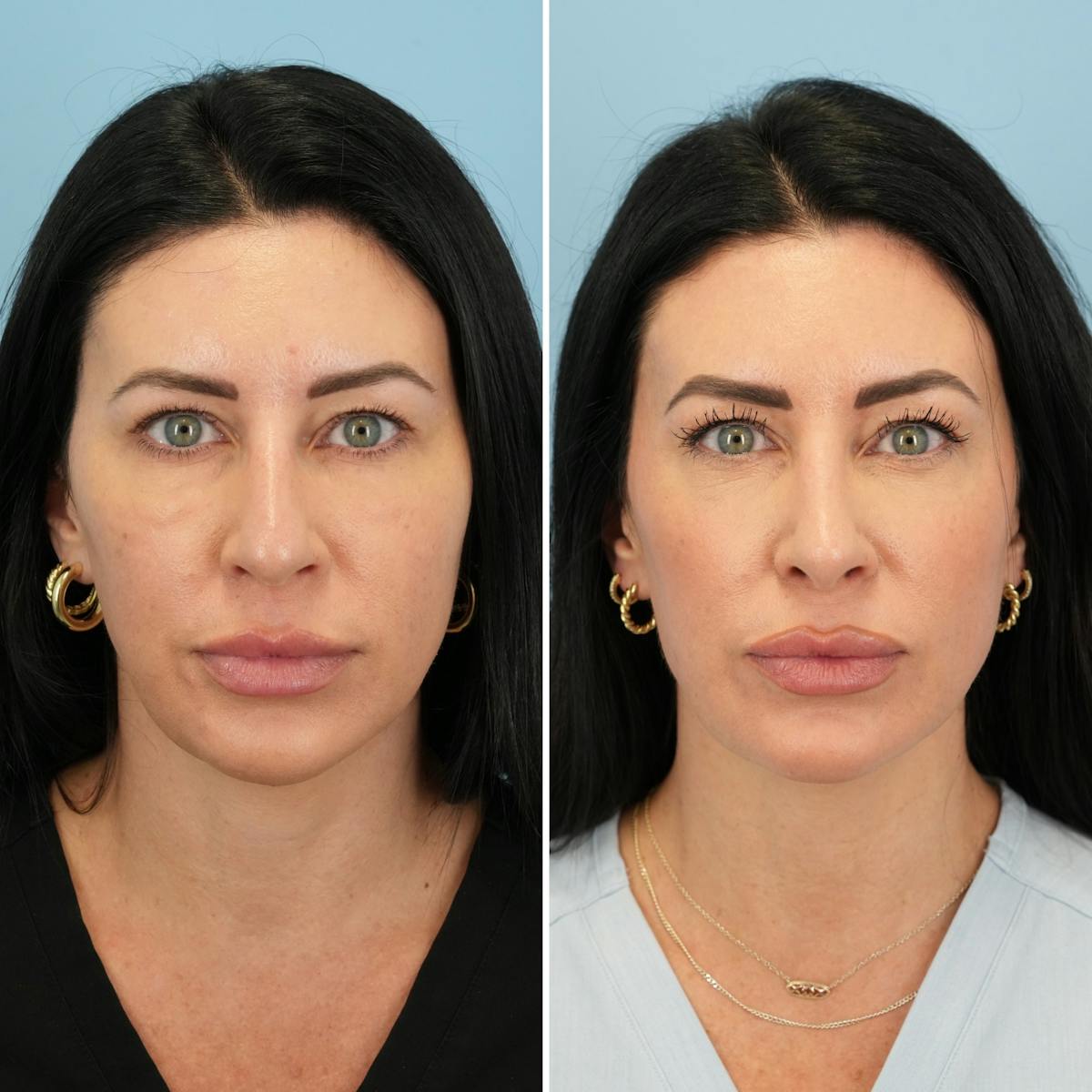 Rhinoplasty Before & After Gallery - Patient 132503 - Image 5