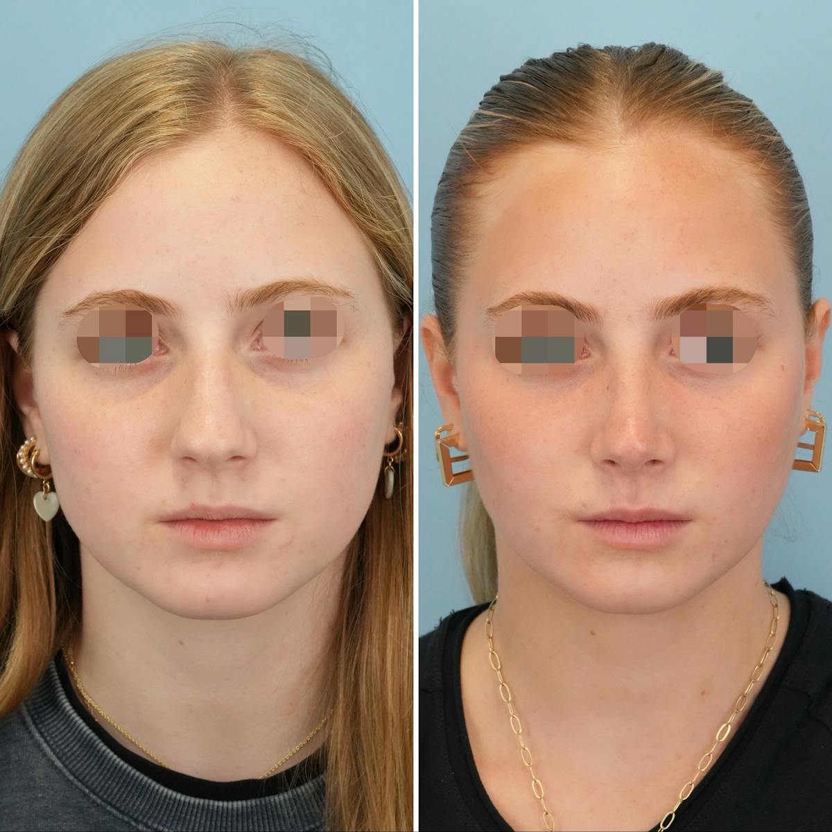 Rhinoplasty Before & After Gallery - Patient 438284 - Image 5