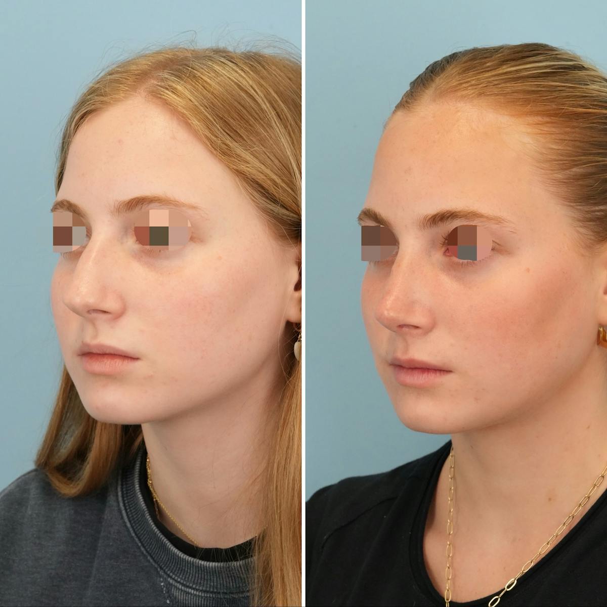 Rhinoplasty Before & After Gallery - Patient 438284 - Image 7