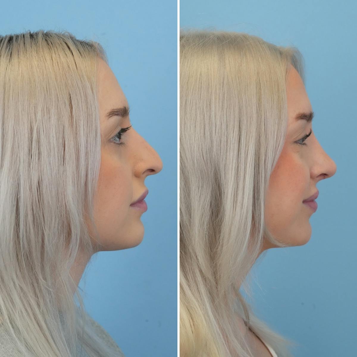 Rhinoplasty Before & After Gallery - Patient 565624 - Image 1