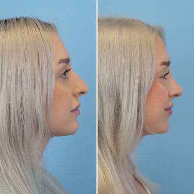 Rhinoplasty Before & After Gallery - Patient 565624 - Image 1