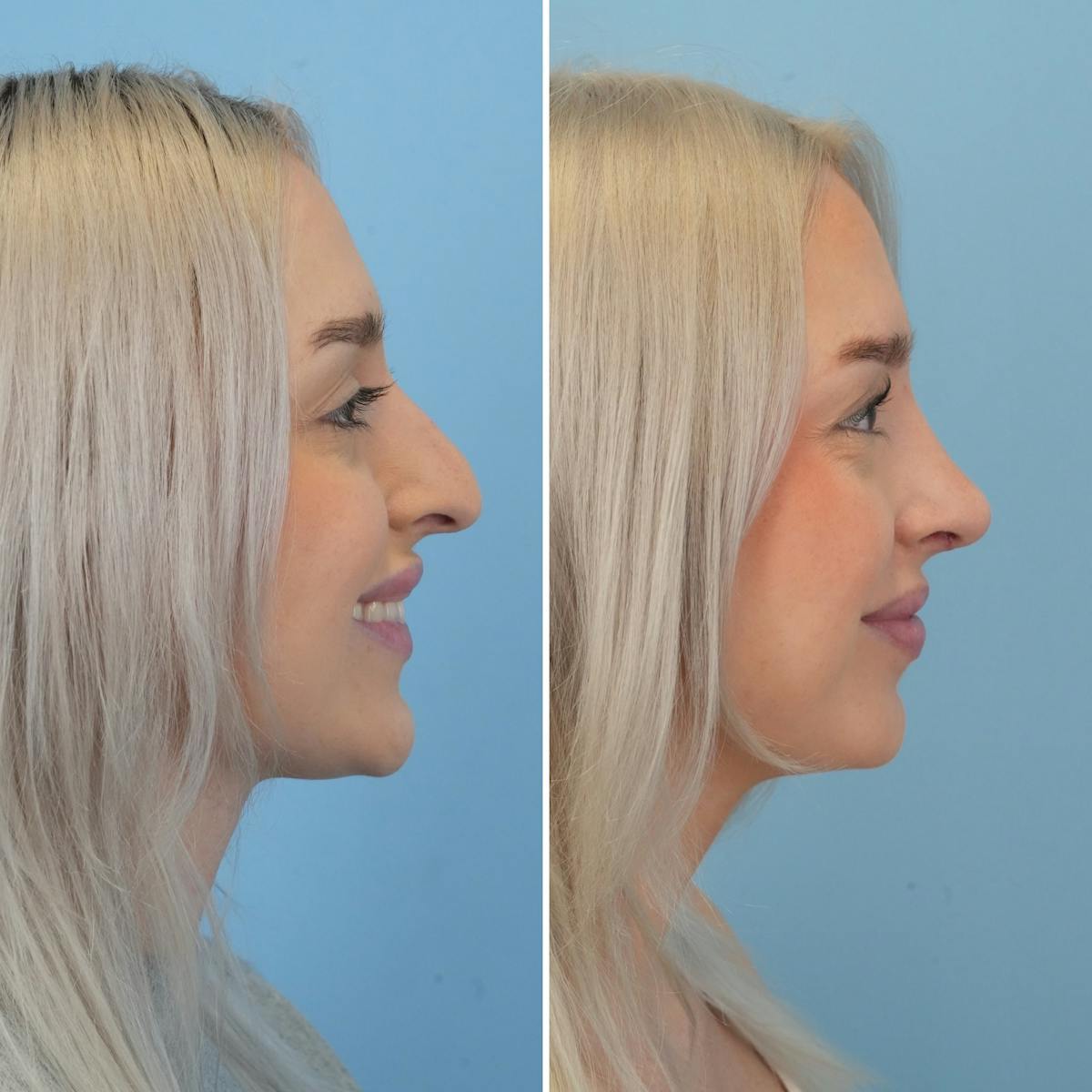 Rhinoplasty Before & After Gallery - Patient 565624 - Image 2