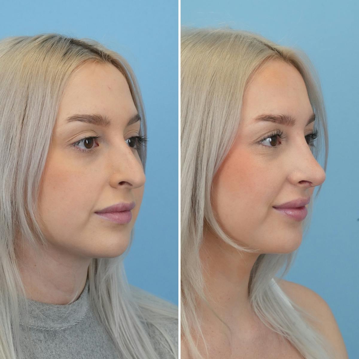 Rhinoplasty Before & After Gallery - Patient 565624 - Image 3