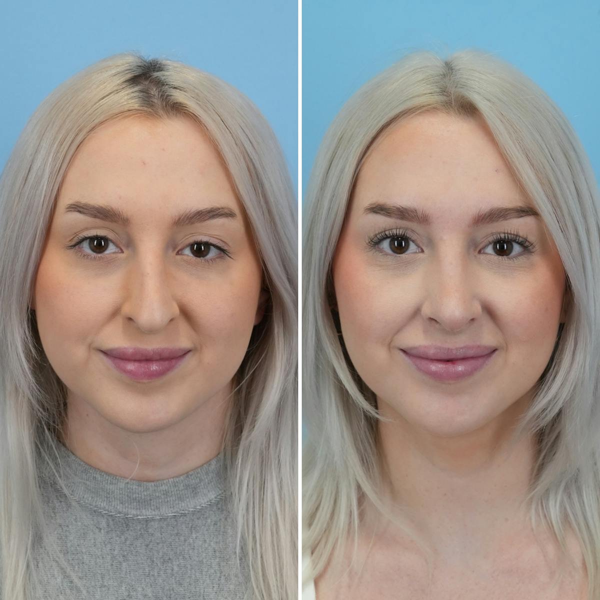 Rhinoplasty Before & After Gallery - Patient 565624 - Image 4