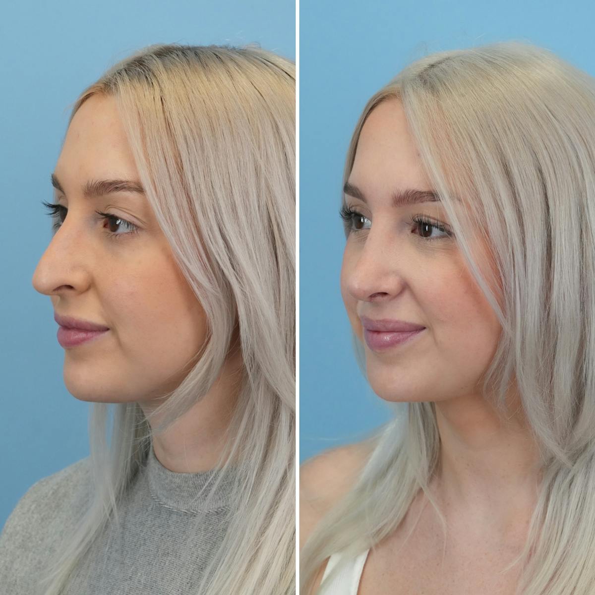 Rhinoplasty Before & After Gallery - Patient 565624 - Image 5