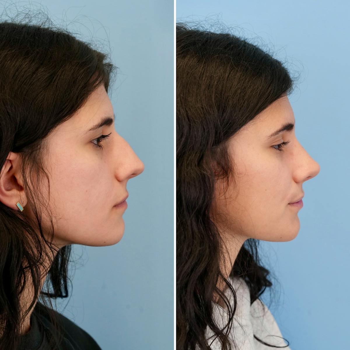 Rhinoplasty Before & After Gallery - Patient 198590 - Image 1