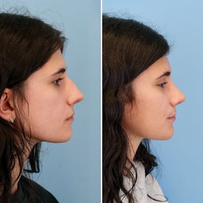 Rhinoplasty Before & After Gallery - Patient 198590 - Image 1
