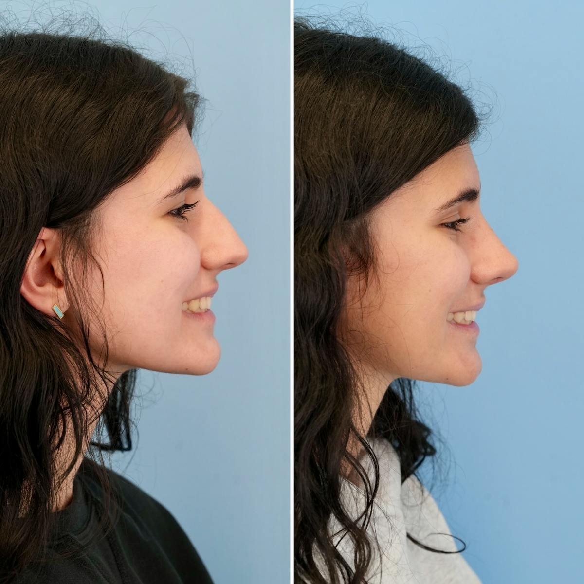 Rhinoplasty Before & After Gallery - Patient 198590 - Image 2