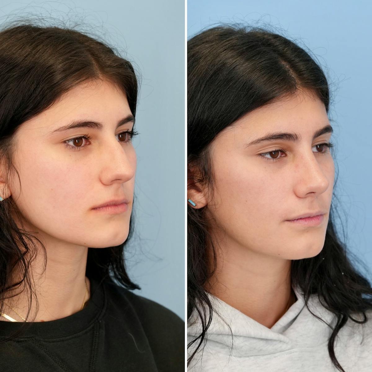 Rhinoplasty Before & After Gallery - Patient 198590 - Image 3