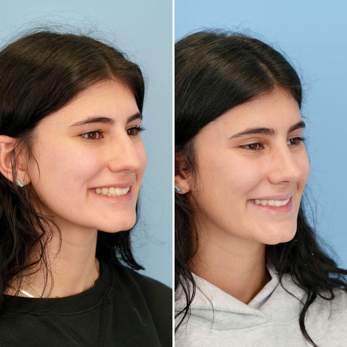 Rhinoplasty Before & After Gallery - Patient 198590 - Image 4