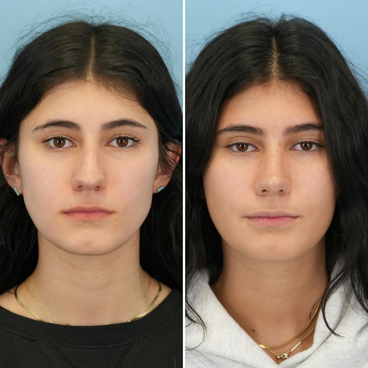 Rhinoplasty Before & After Gallery - Patient 198590 - Image 5