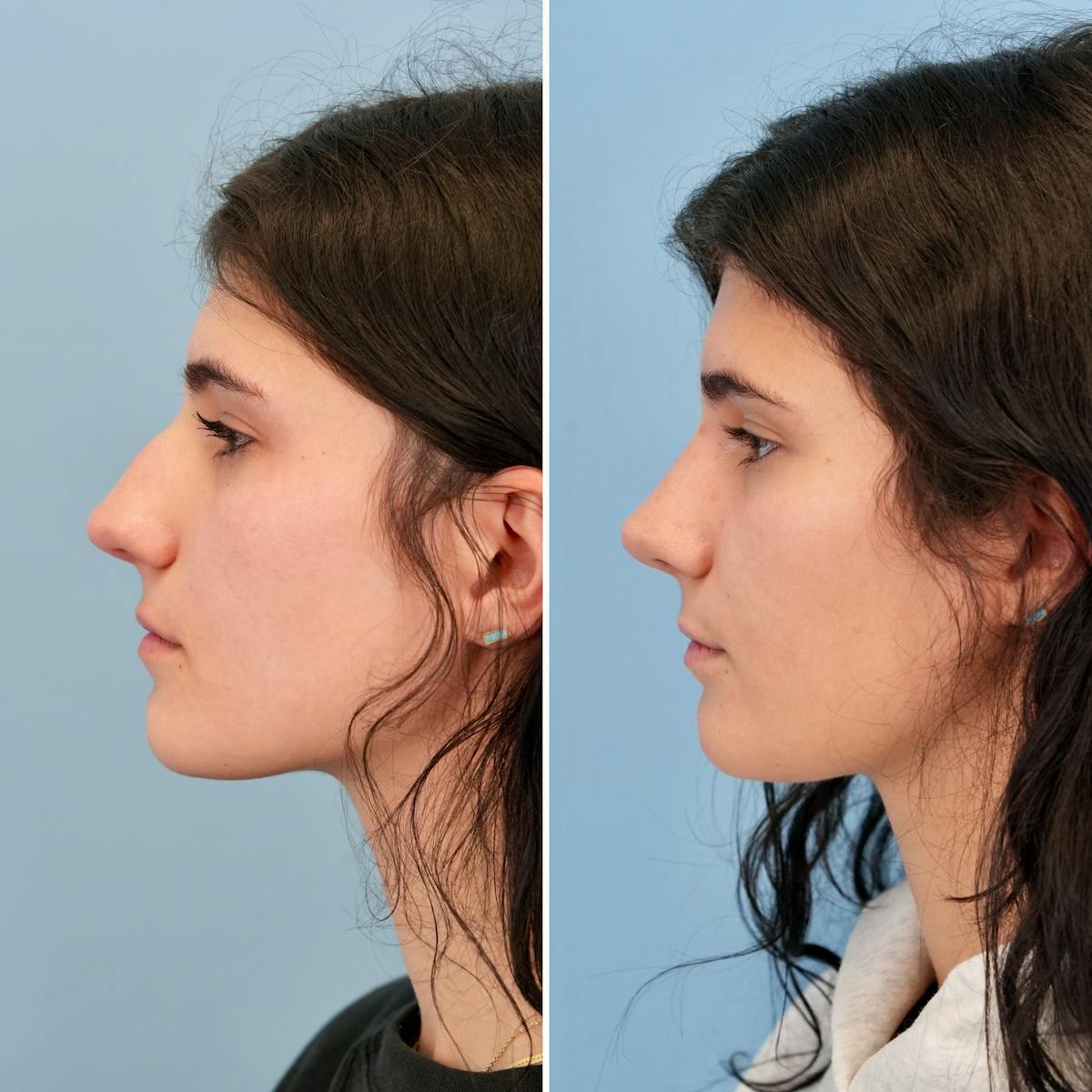 Rhinoplasty Before & After Gallery - Patient 198590 - Image 8