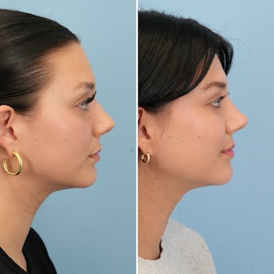 Rhinoplasty Before & After Gallery - Patient 189885 - Image 1