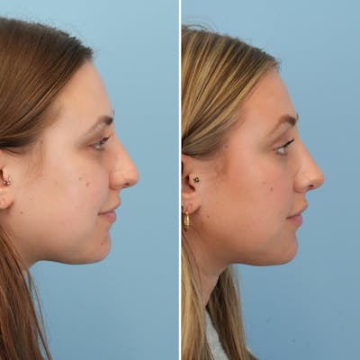Rhinoplasty Before & After Gallery - Patient 697678 - Image 1