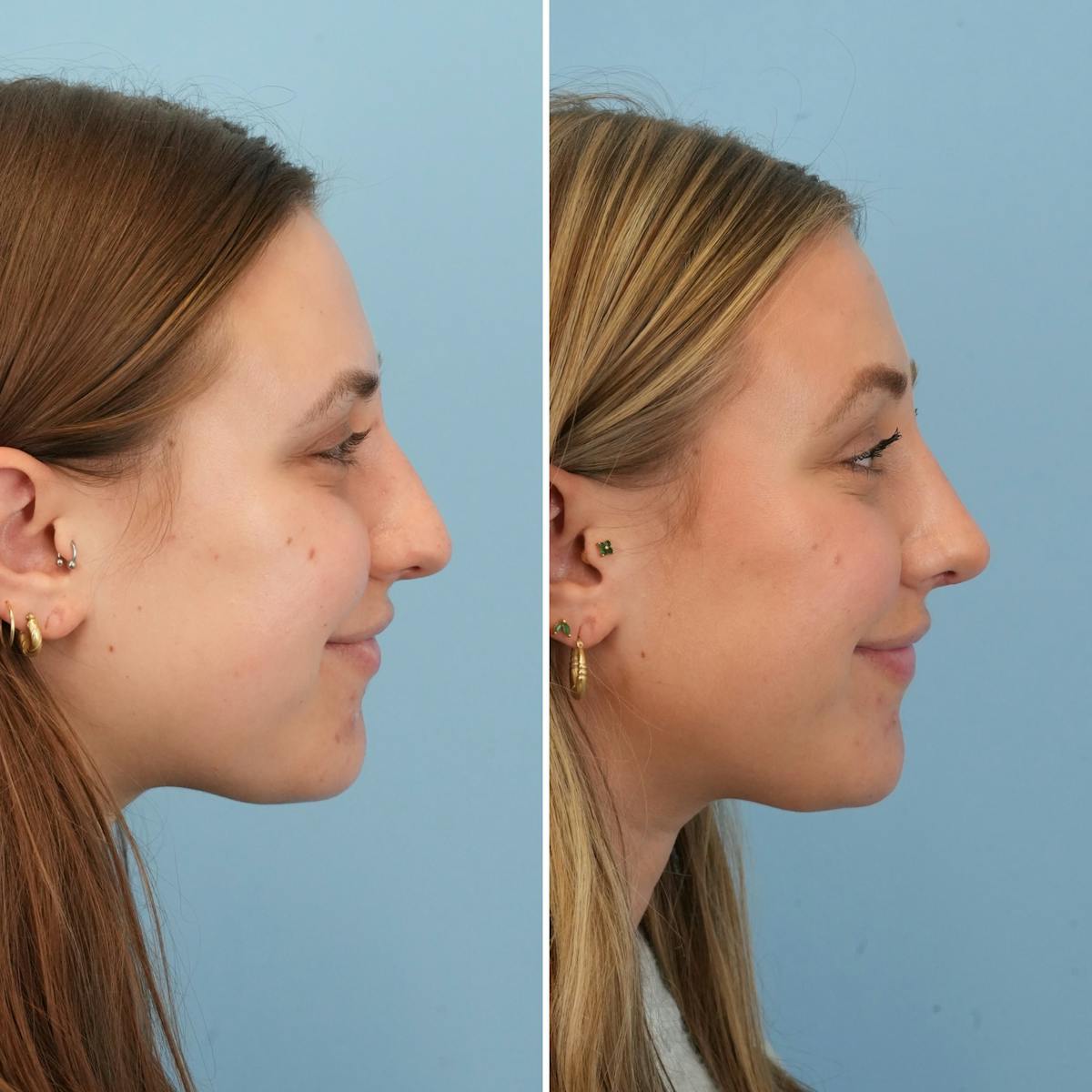Rhinoplasty Before & After Gallery - Patient 697678 - Image 2