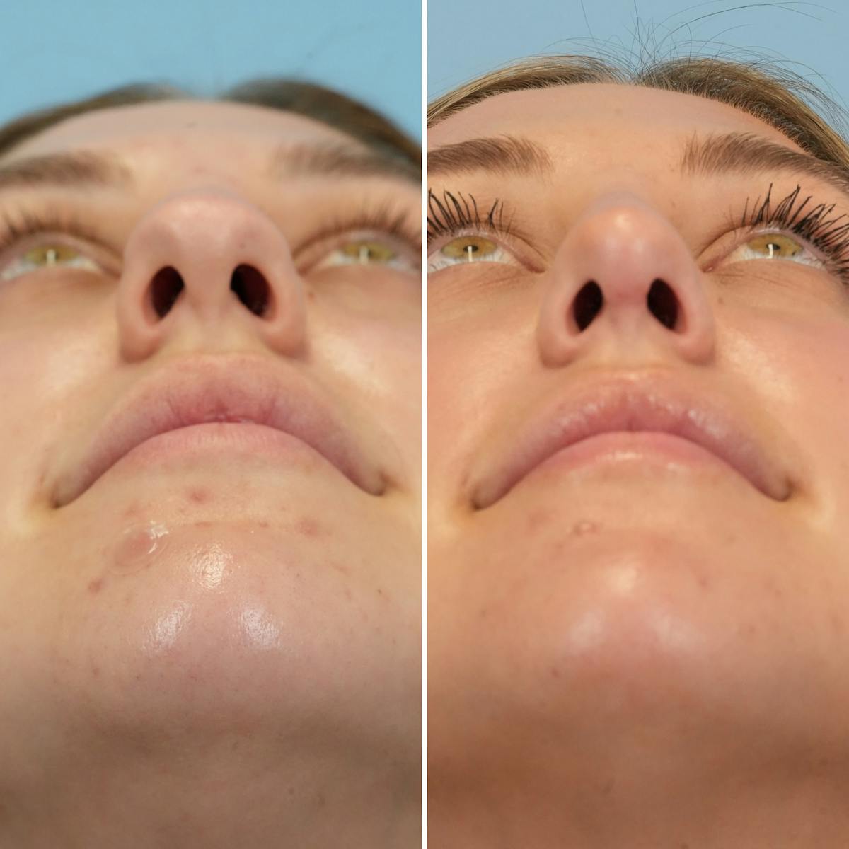 Rhinoplasty Before & After Gallery - Patient 697678 - Image 4