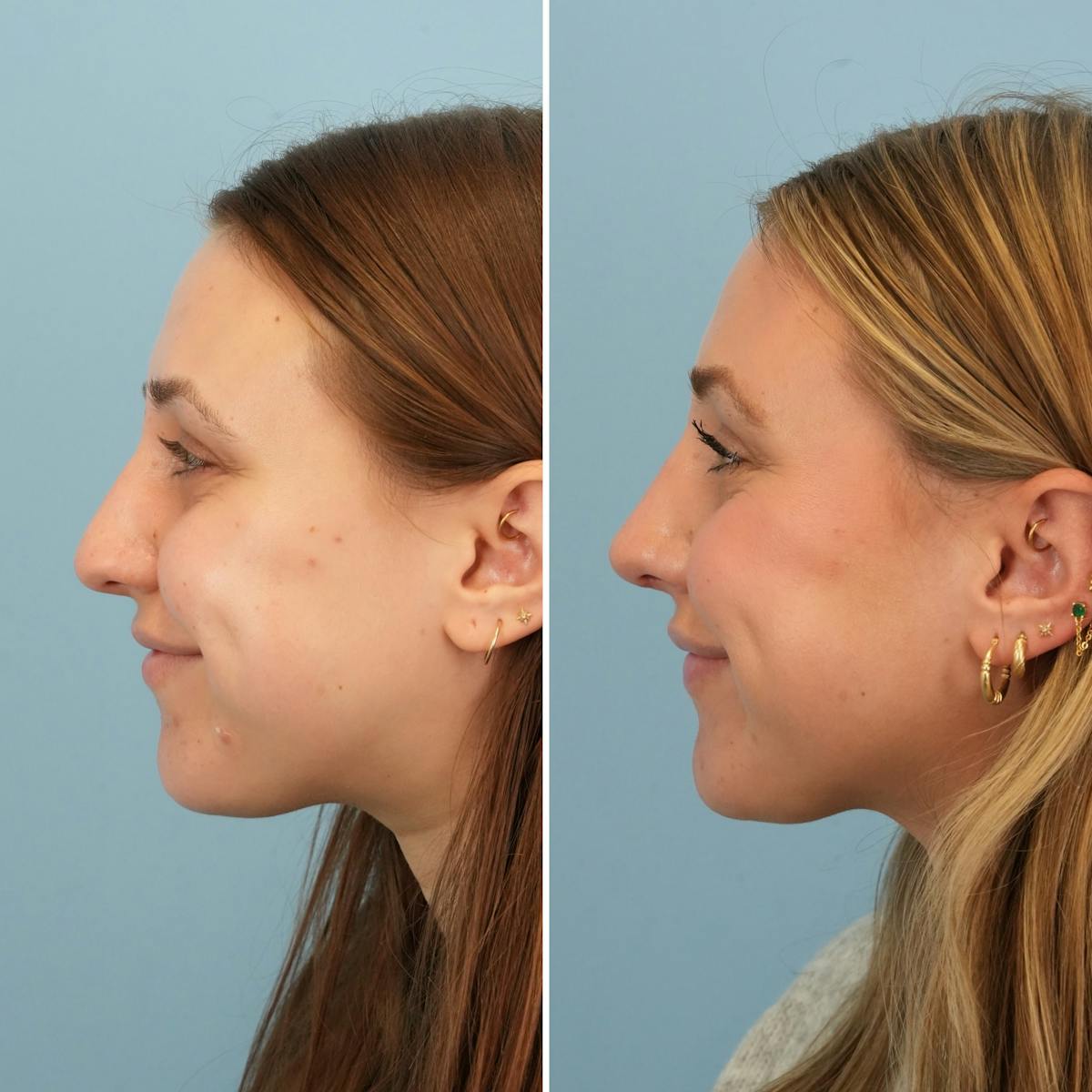 Rhinoplasty Before & After Gallery - Patient 697678 - Image 6