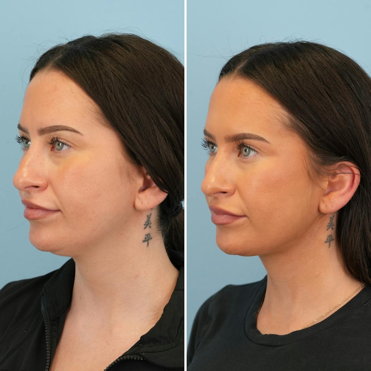 Submental Liposuction Before & After Gallery - Patient 424846 - Image 2