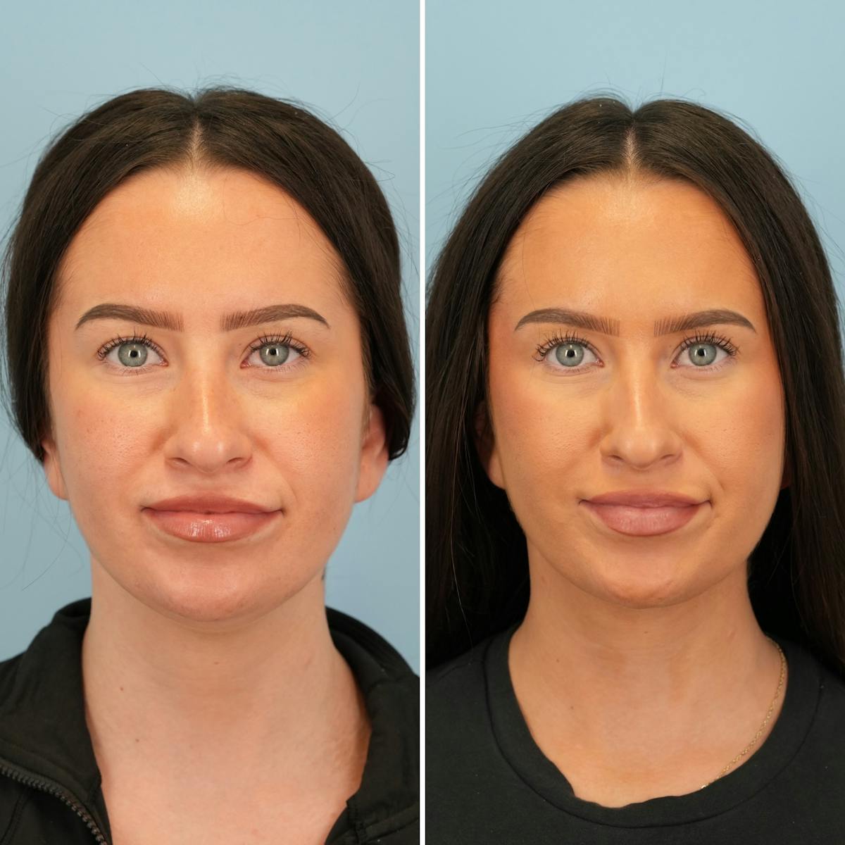 Submental Liposuction Before & After Gallery - Patient 424846 - Image 3