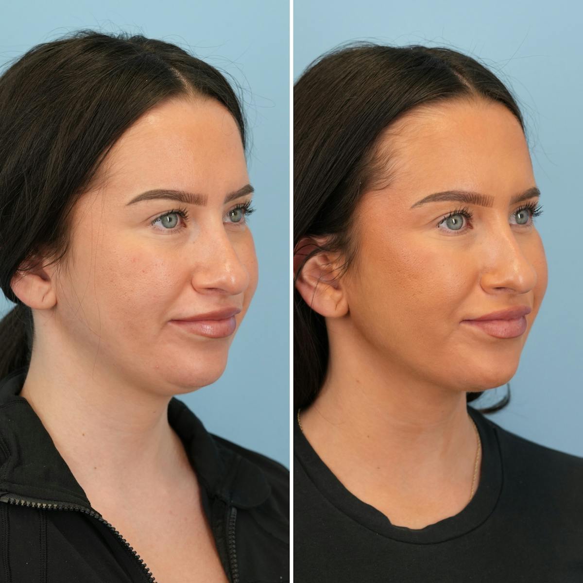 Submental Liposuction Before & After Gallery - Patient 424846 - Image 4