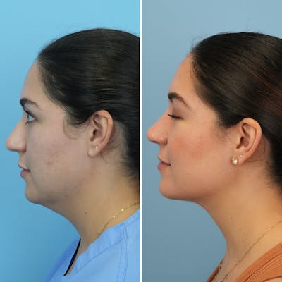 Submental Liposuction Before & After Gallery - Patient 191665 - Image 1