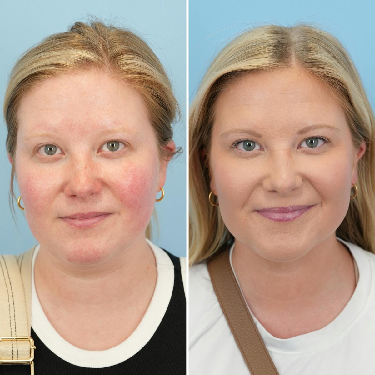 Submental Liposuction Before & After Gallery - Patient 148497 - Image 3